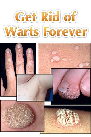 Get Rid of Warts Forever 1.0